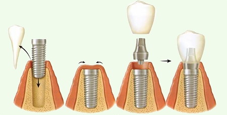 процесс имплантации зубов